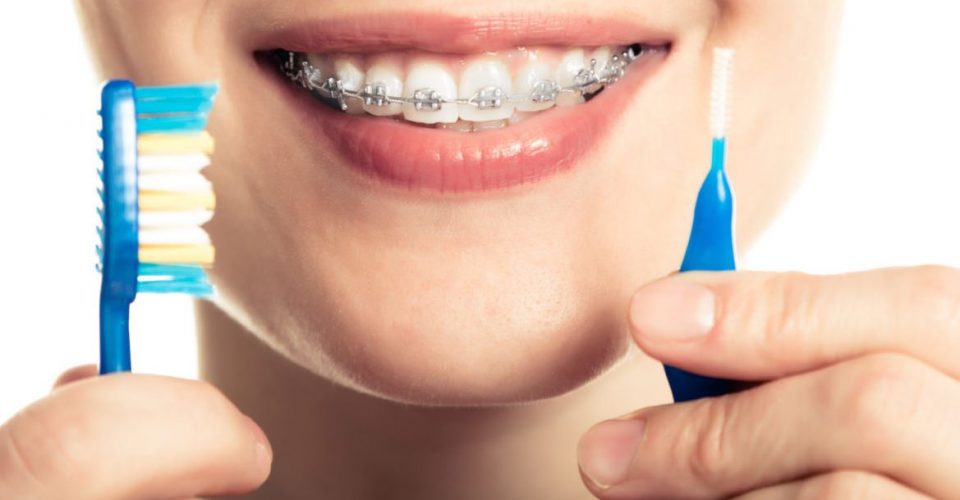 6 consigli per gestire quotidianamente l'apparecchio per i denti